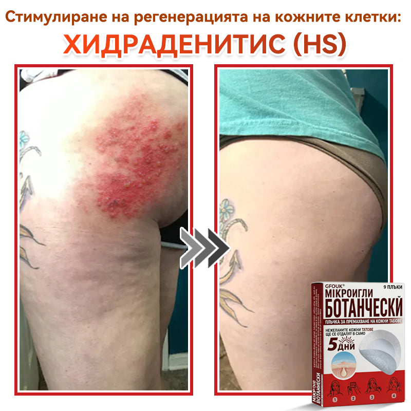 🎁 Остават само 5 пакета! Сега можете да получите допълнителна 50% ОТСТЪПКА! Помага видимо да се намалят фибромите, брадавиците и други кожни несъвършенства — бързо, удобно и безболезнено. 🌿