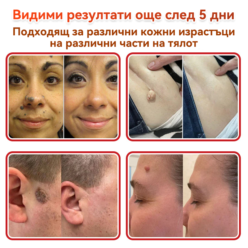 🎁 Остават само 5 пакета! Сега можете да получите допълнителна 50% ОТСТЪПКА! Помага видимо да се намалят фибромите, брадавиците и други кожни несъвършенства — бързо, удобно и безболезнено. 🌿
