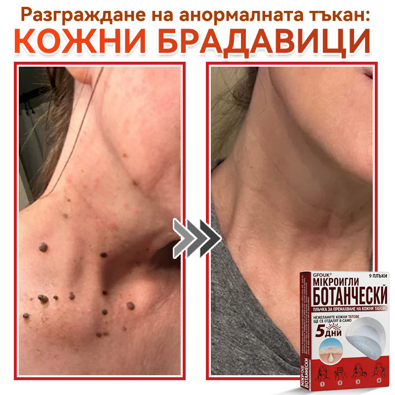 🎁 Остават само 5 пакета! Сега можете да получите допълнителна 50% ОТСТЪПКА! Помага видимо да се намалят фибромите, брадавиците и други кожни несъвършенства — бързо, удобно и безболезнено. 🌿