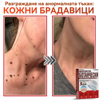 🎁 Остават само 5 пакета! Сега можете да получите допълнителна 50% ОТСТЪПКА! Помага видимо да се намалят фибромите, брадавиците и други кожни несъвършенства — бързо, удобно и безболезнено. 🌿