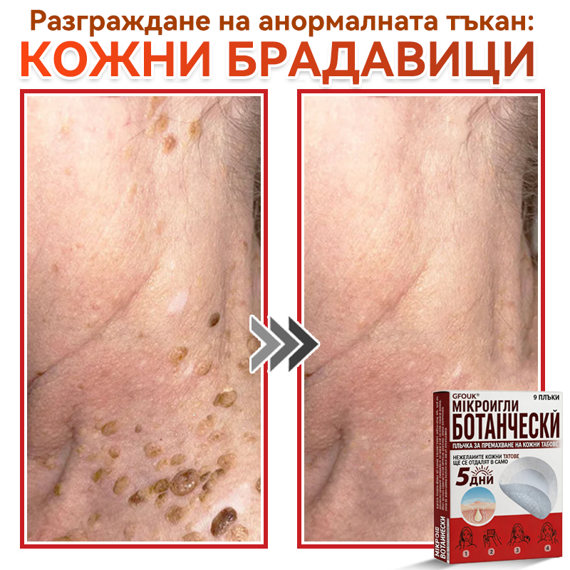 🎁 Остават само 5 пакета! Сега можете да получите допълнителна 50% ОТСТЪПКА! Помага видимо да се намалят фибромите, брадавиците и други кожни несъвършенства — бързо, удобно и безболезнено. 🌿